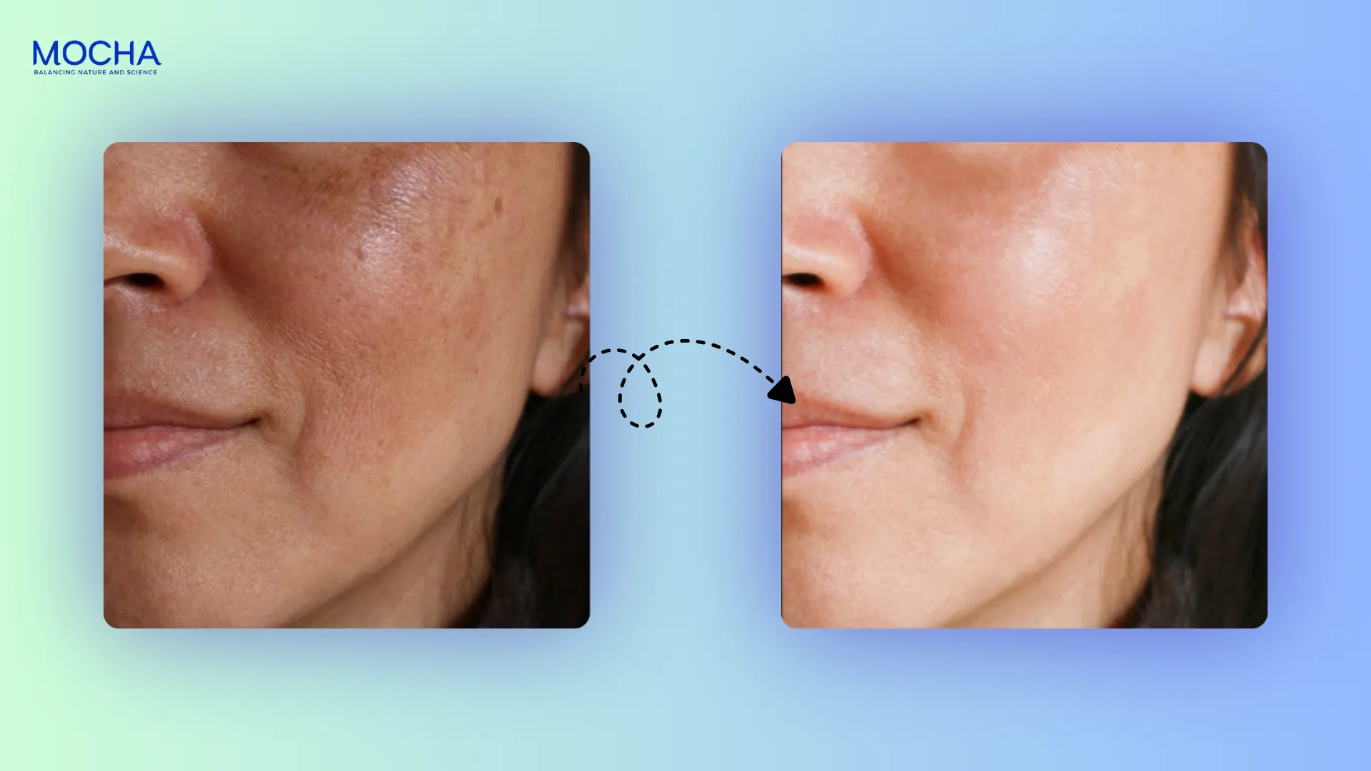Nám mờ đi khi nào? 5 dấu hiệu tích cực khi dùng serum trị nám bạn cần biết