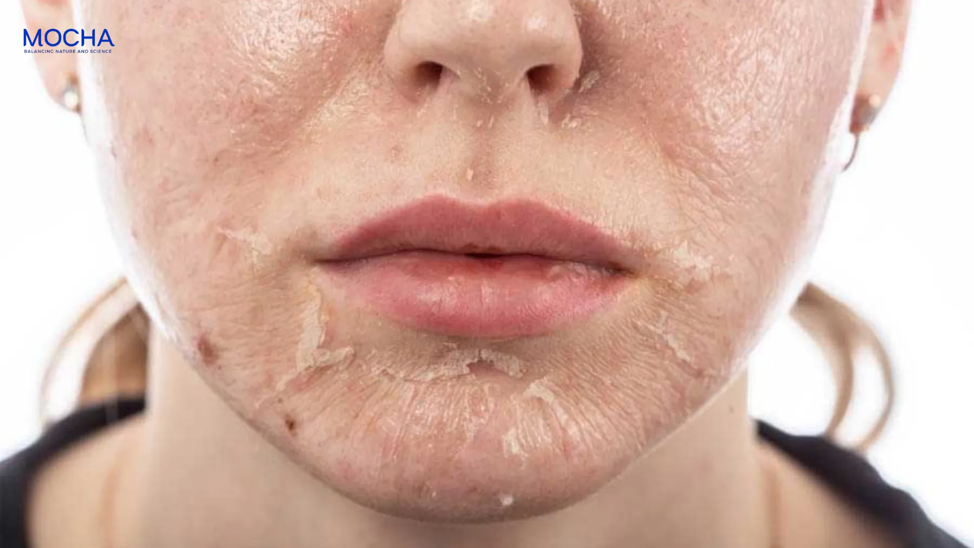 Nám mờ đi khi nào? 5 dấu hiệu tích cực khi dùng serum trị nám bạn cần biết