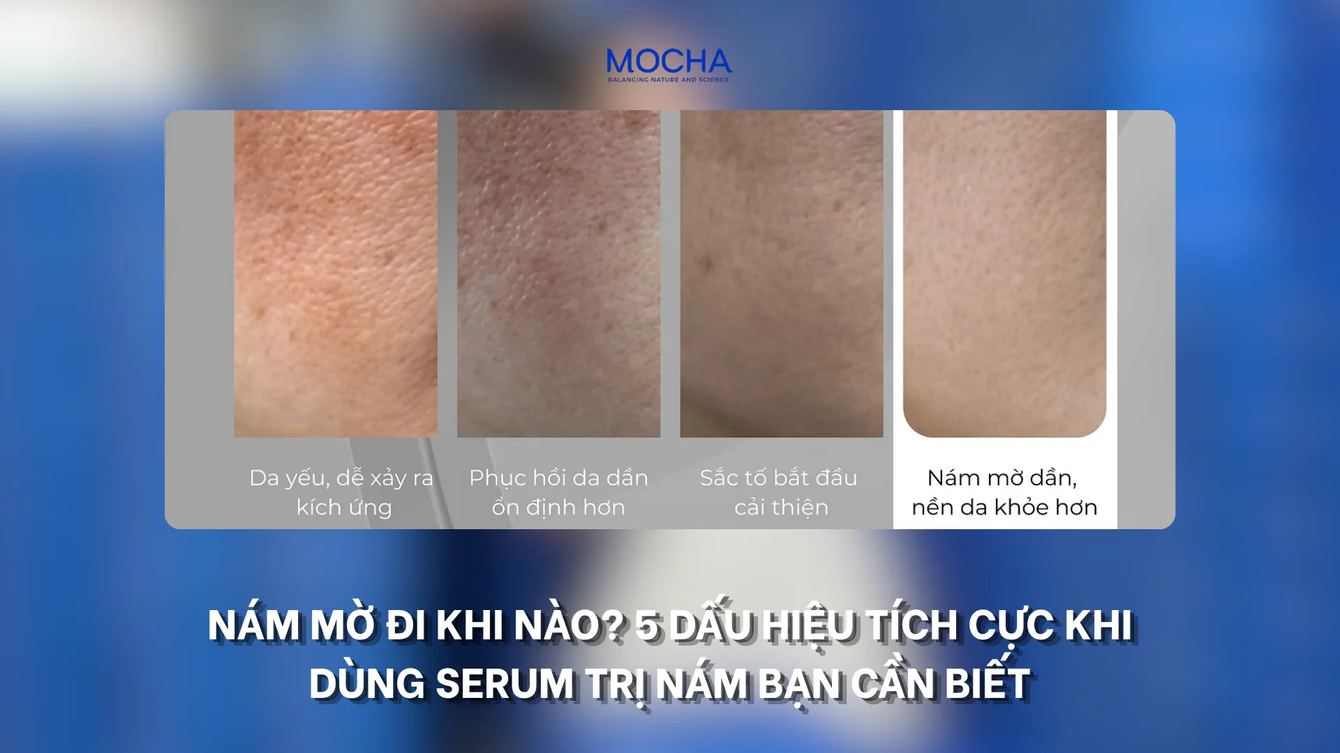 Nám mờ đi khi nào? 5 dấu hiệu tích cực khi dùng serum trị nám bạn cần biết