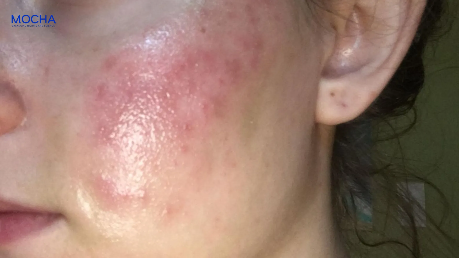 Peel da có tốt không? Giải đáp 4 lợi ích từ chuyên gia