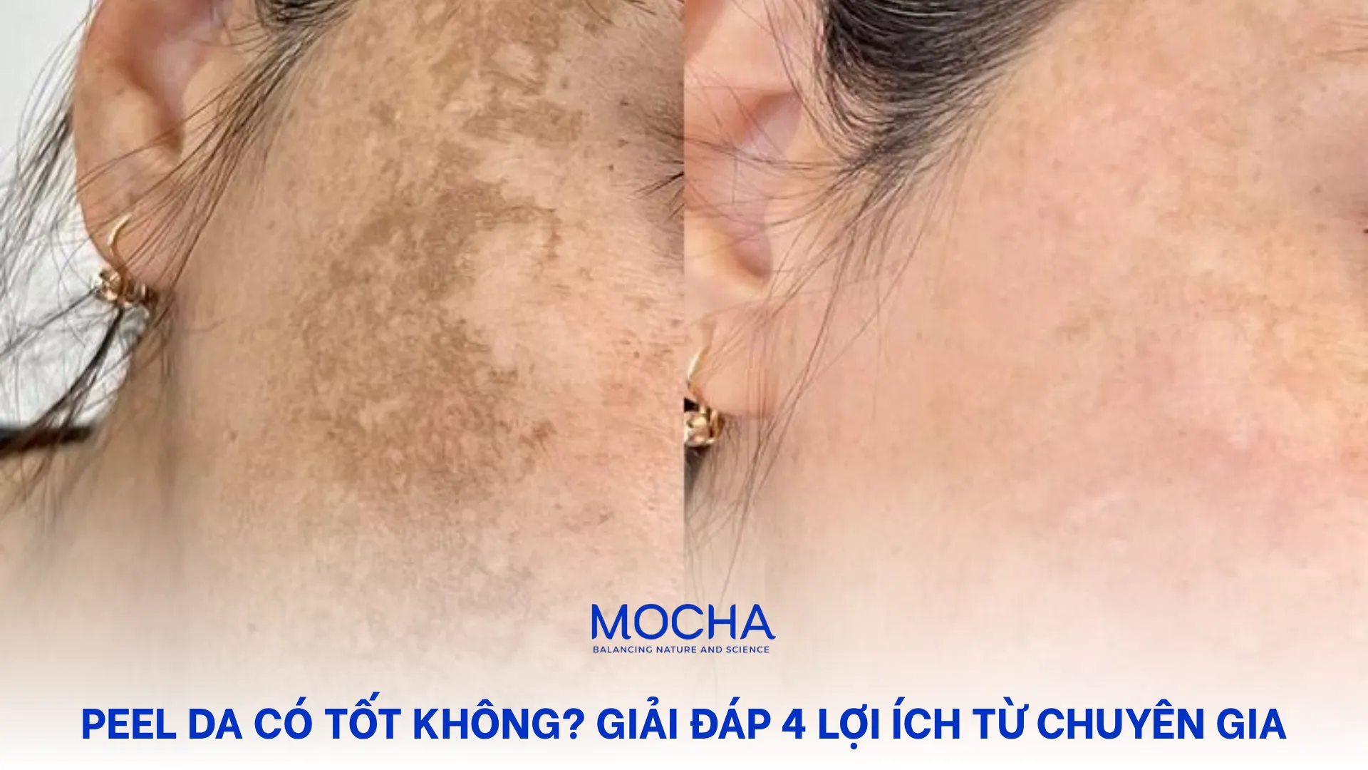 Peel da có tốt không? Giải đáp 4 lợi ích từ chuyên gia