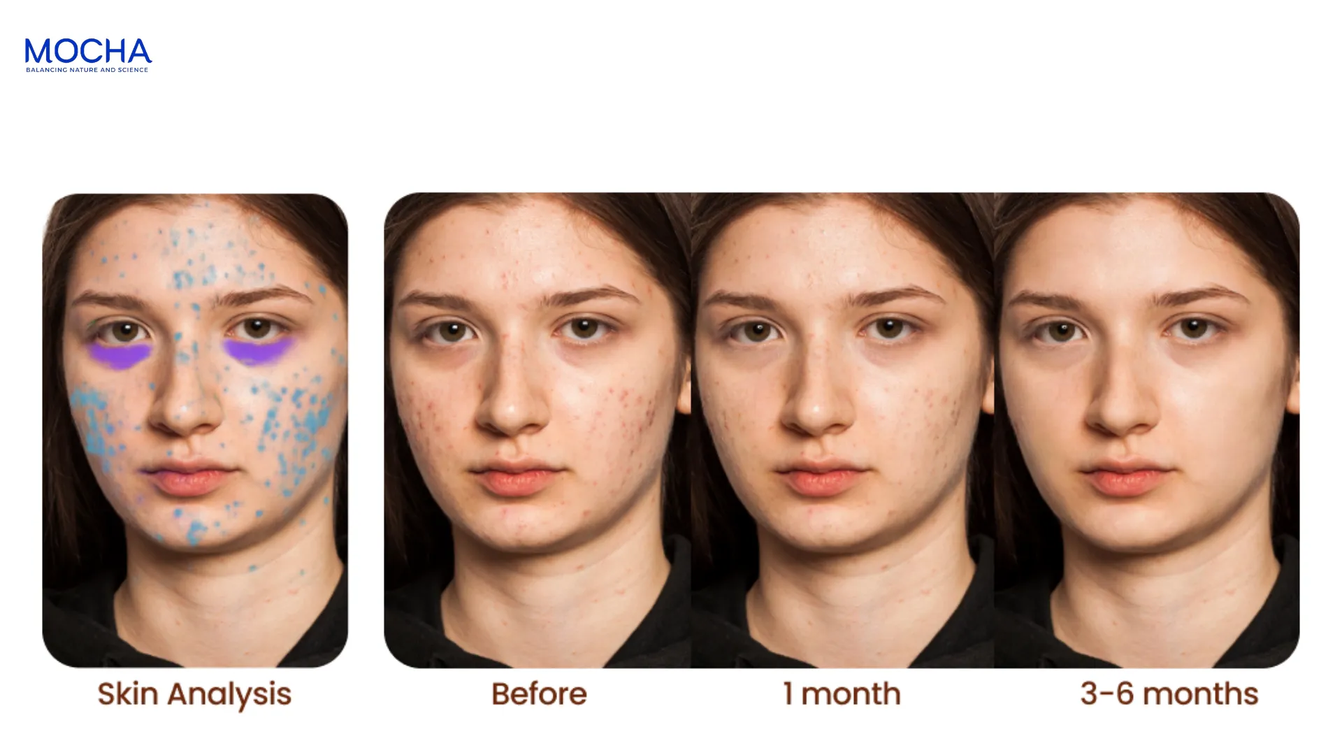 Peel Retinol là gì? 6 sự khác biệt giữa peel hóa học và thay da sinh học