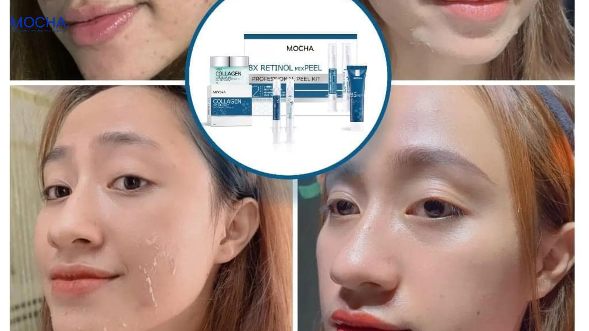 Peel Retinol là gì? 6 sự khác biệt giữa peel hóa học và thay da sinh học