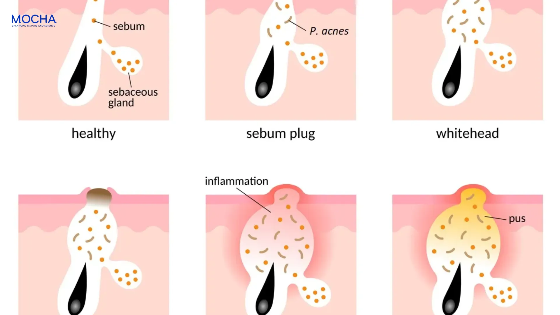 Giải mã thuật ngữ Non-comedogenic: 3 lý do kem dưỡng Mocha không gây mụn?
