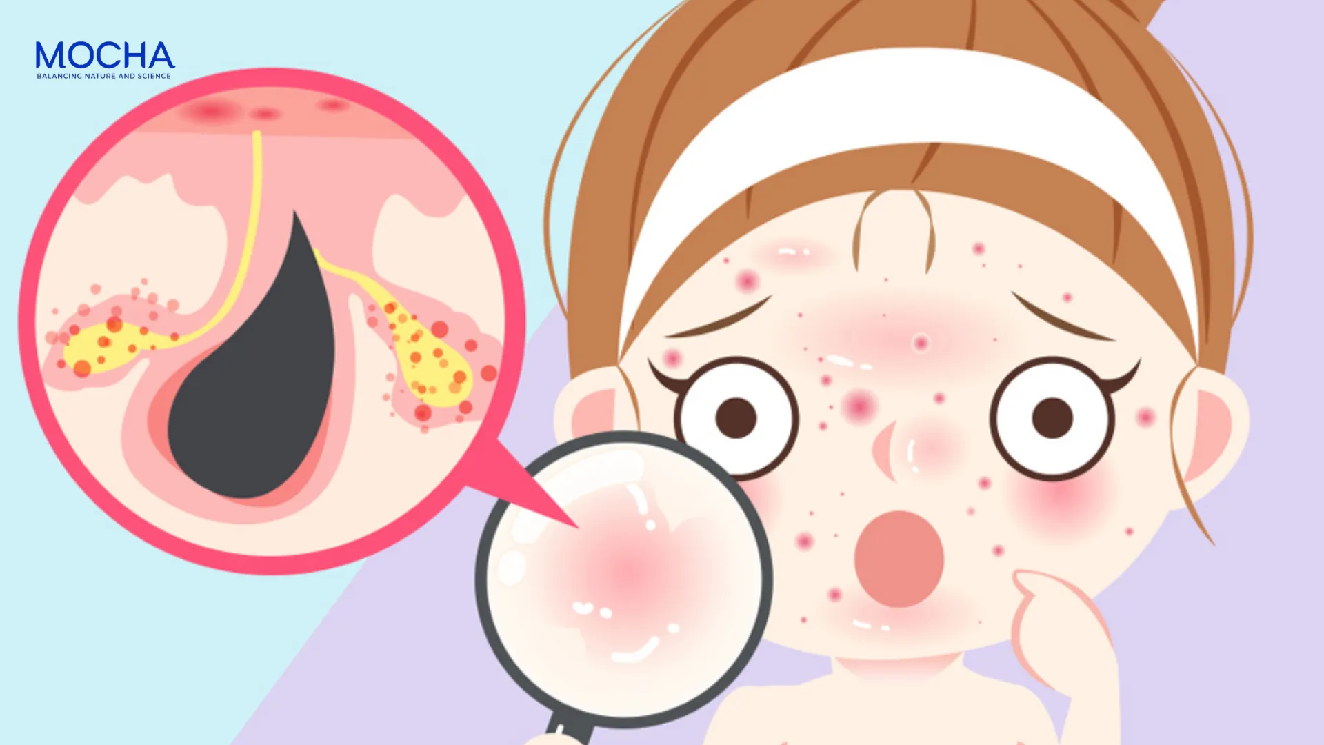 5 bước skincare da dầu mụn tuổi dậy thì tại nhà từ A – Z