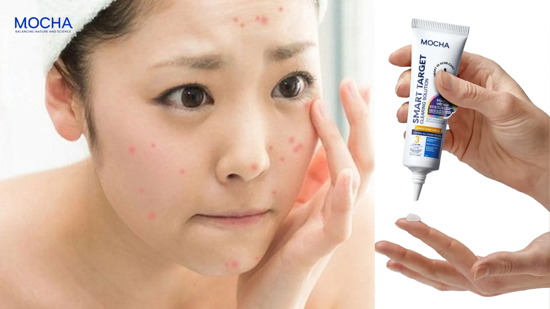 5 bước skincare da dầu mụn tuổi dậy thì tại nhà từ A – Z
