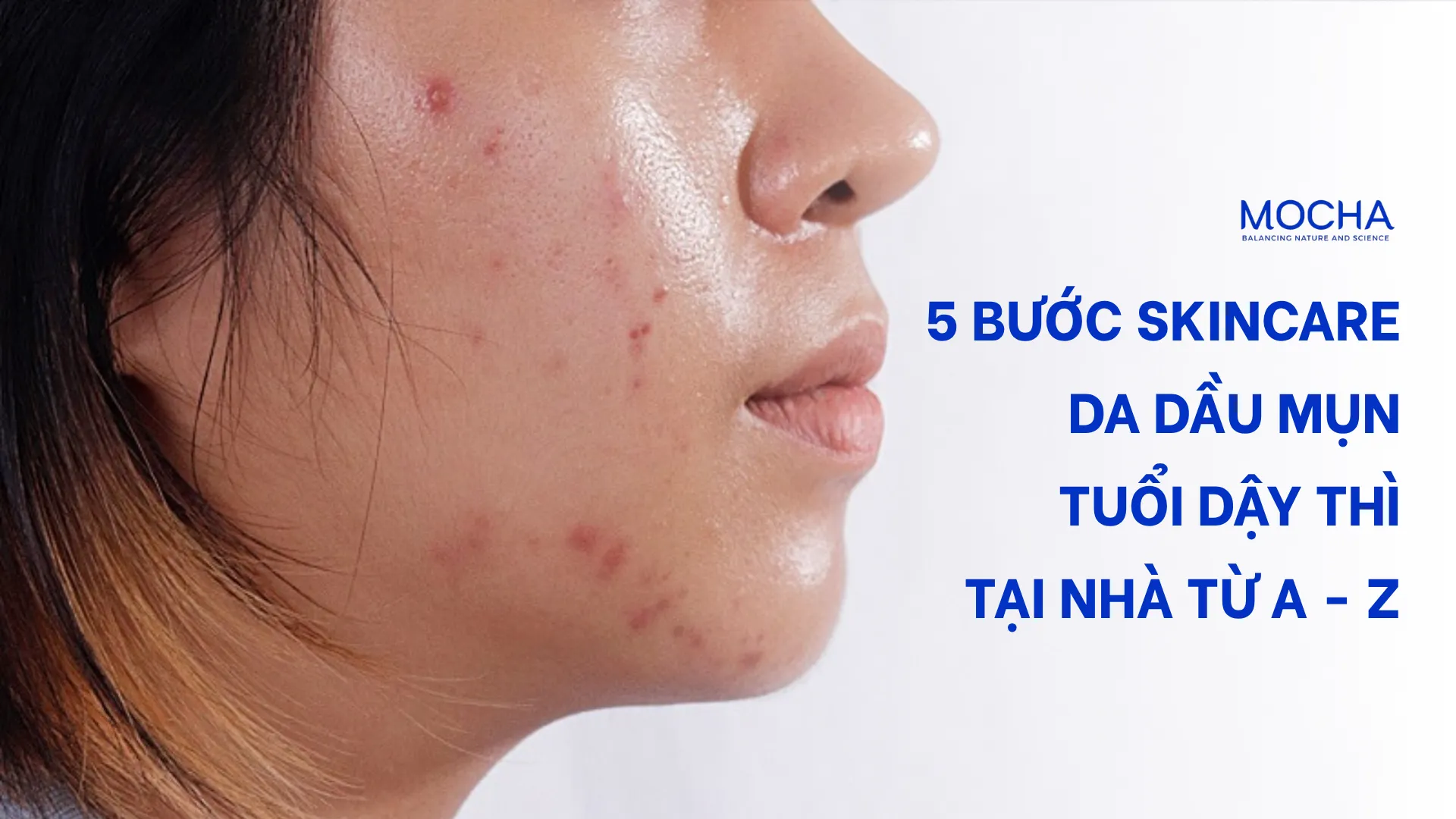 5 bước skincare da dầu mụn tuổi dậy thì tại nhà từ A – Z