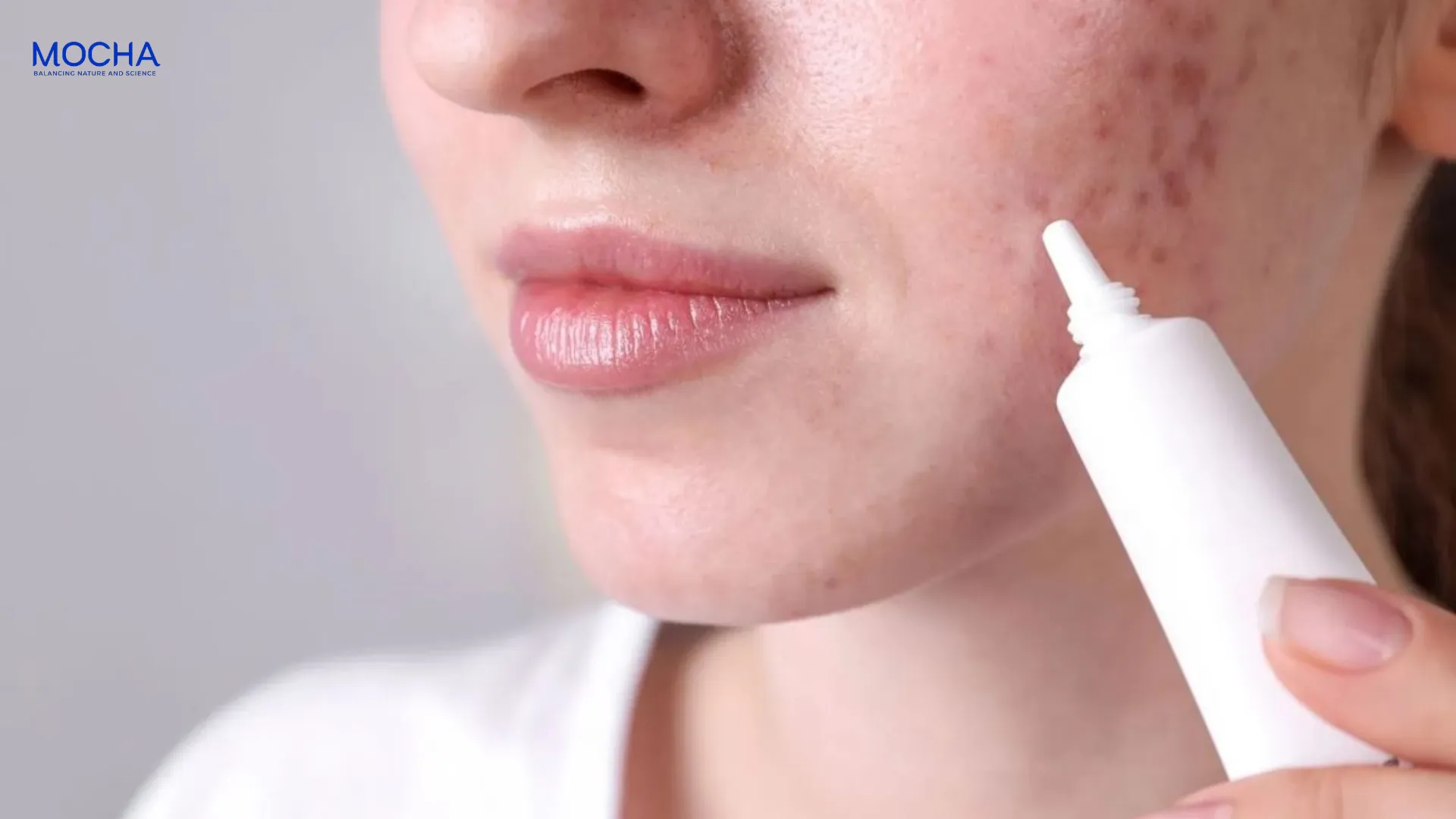 Khi nào nên dùng thuốc bôi mụn, khi nào nên dùng kem dưỡng giảm mụn?
