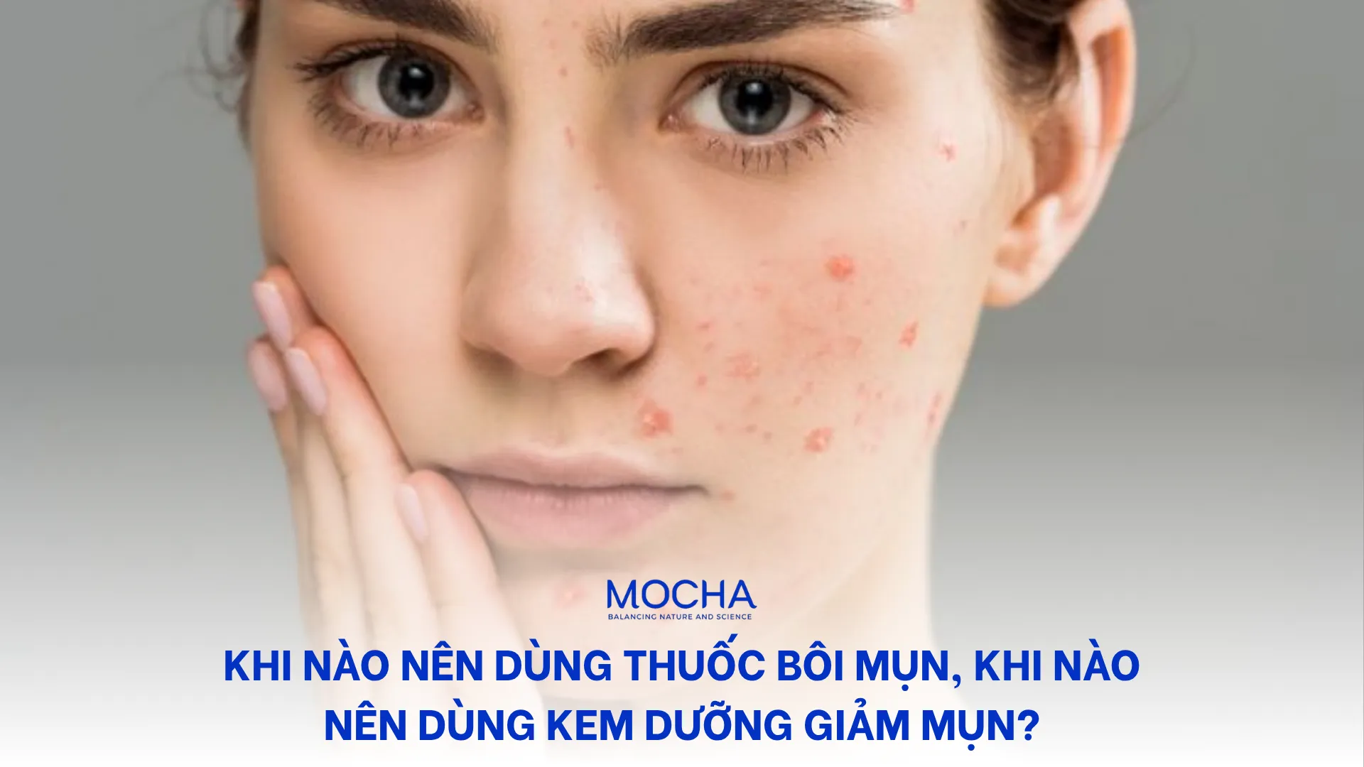 Khi nào nên dùng thuốc bôi mụn, khi nào nên dùng kem dưỡng giảm mụn?