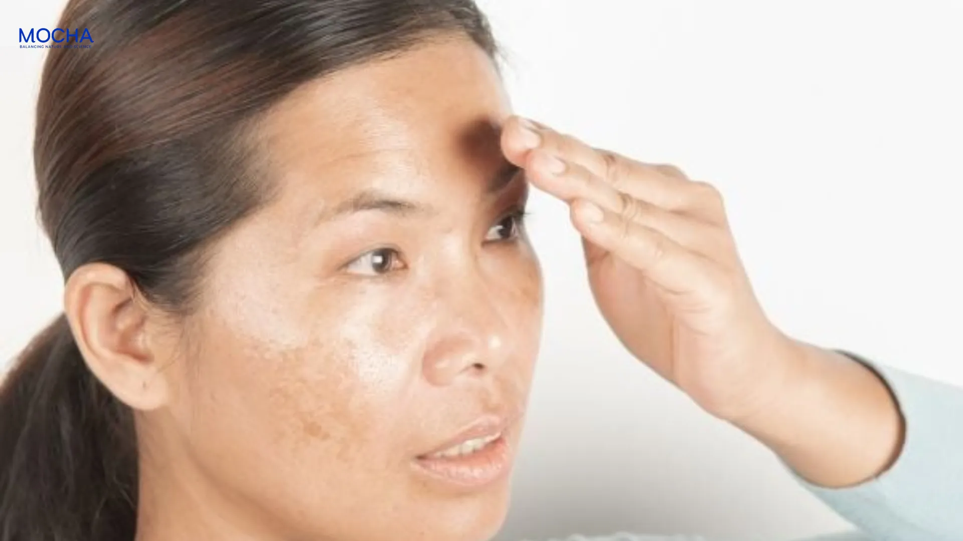 5 quy tắc trị thâm mụn tuổi dậy thì mà các học sinh không được quên