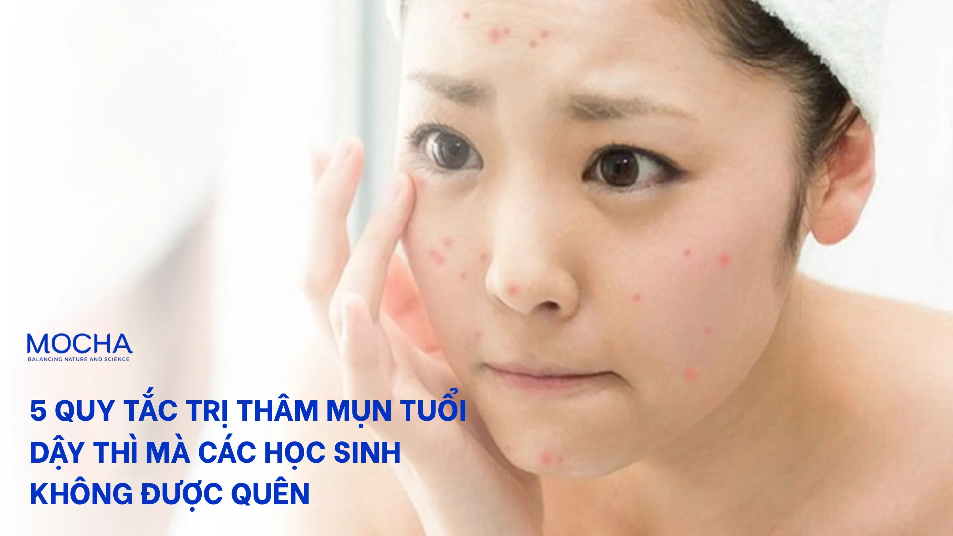 5 quy tắc trị thâm mụn tuổi dậy thì mà các học sinh không được quên