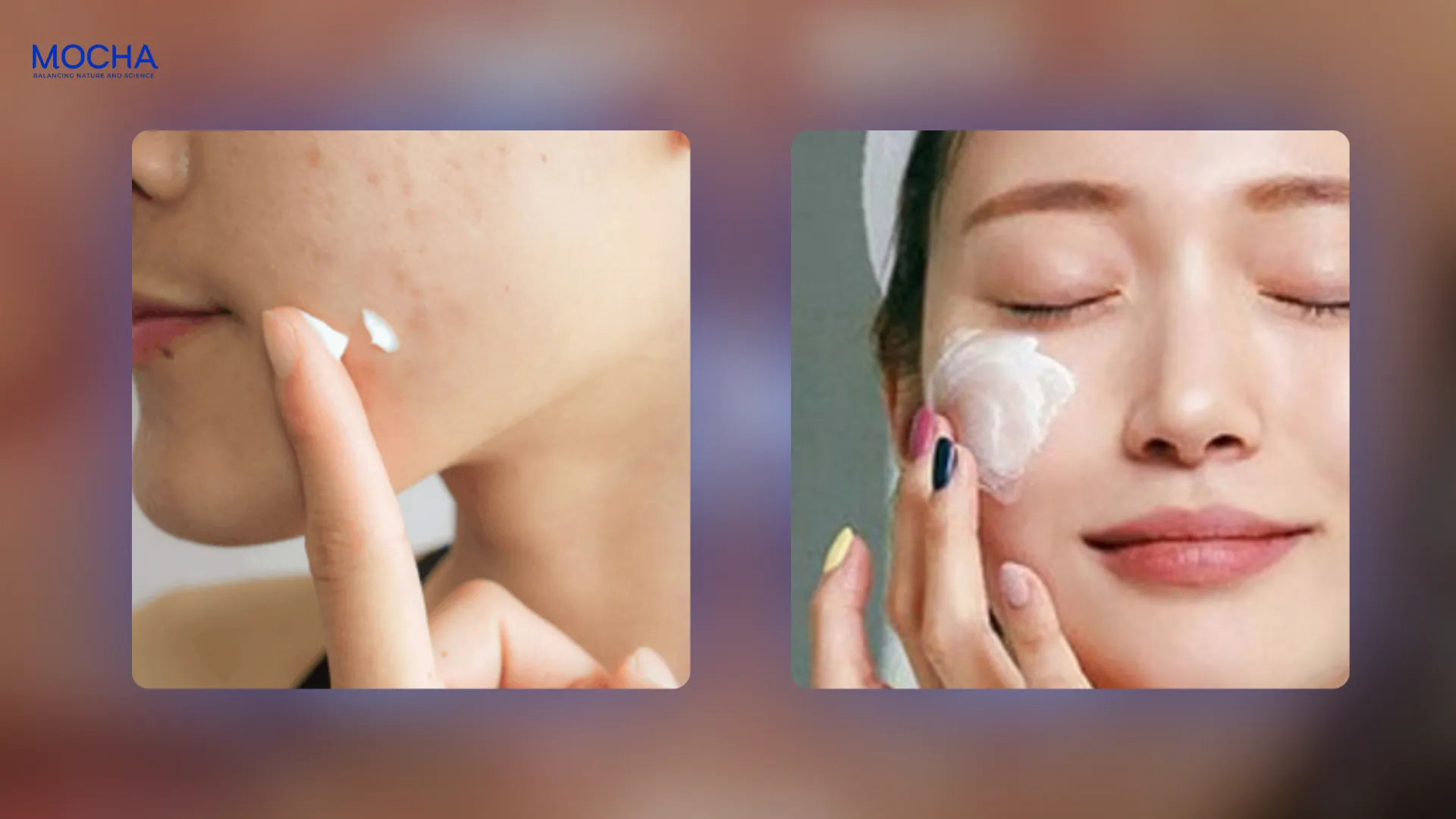 Sự thật về các tuýp trị mụn và 3 tiêu chí lựa chọn phù hợp