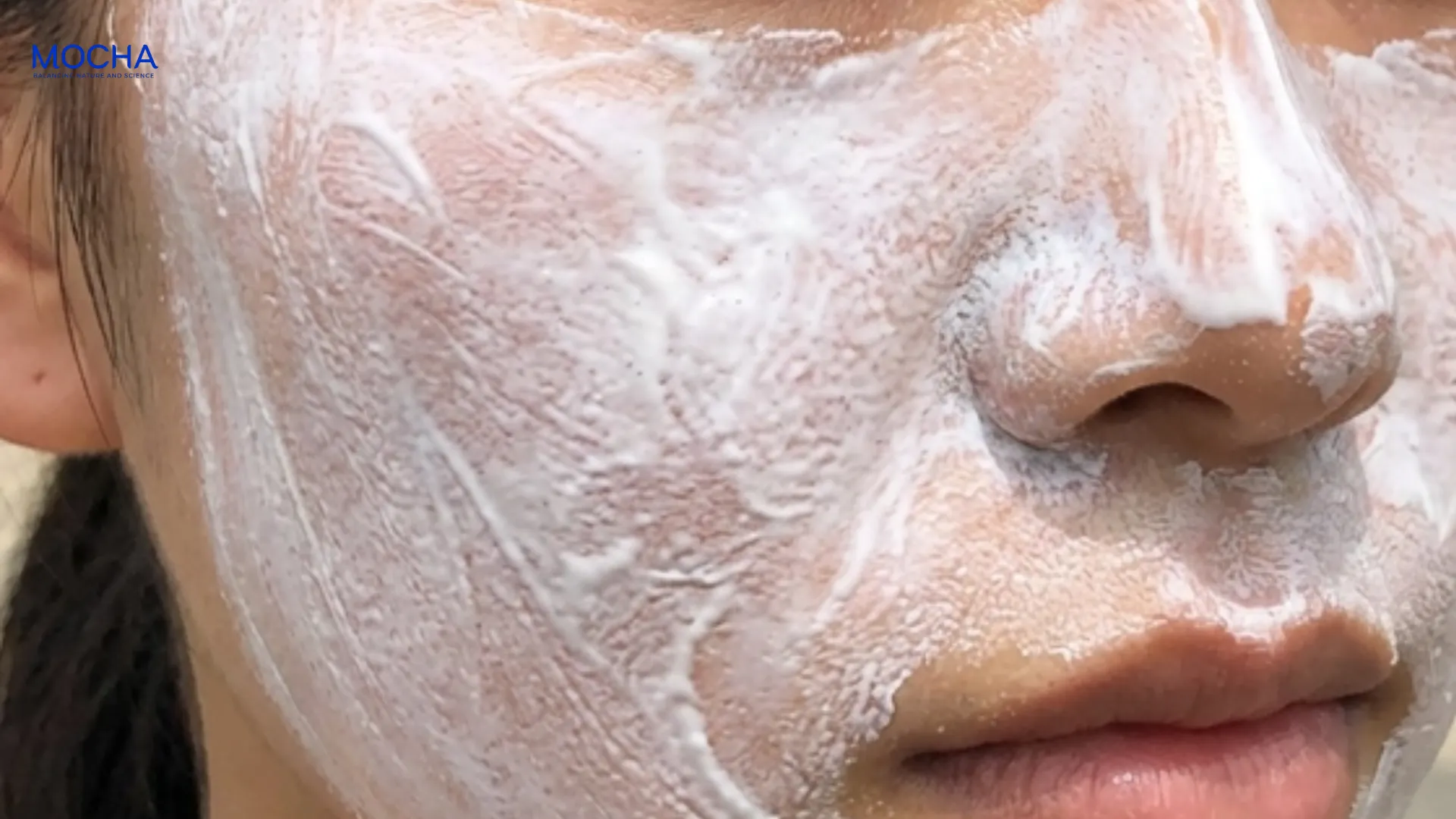 Sự thật về các tuýp trị mụn và 3 tiêu chí lựa chọn phù hợp
