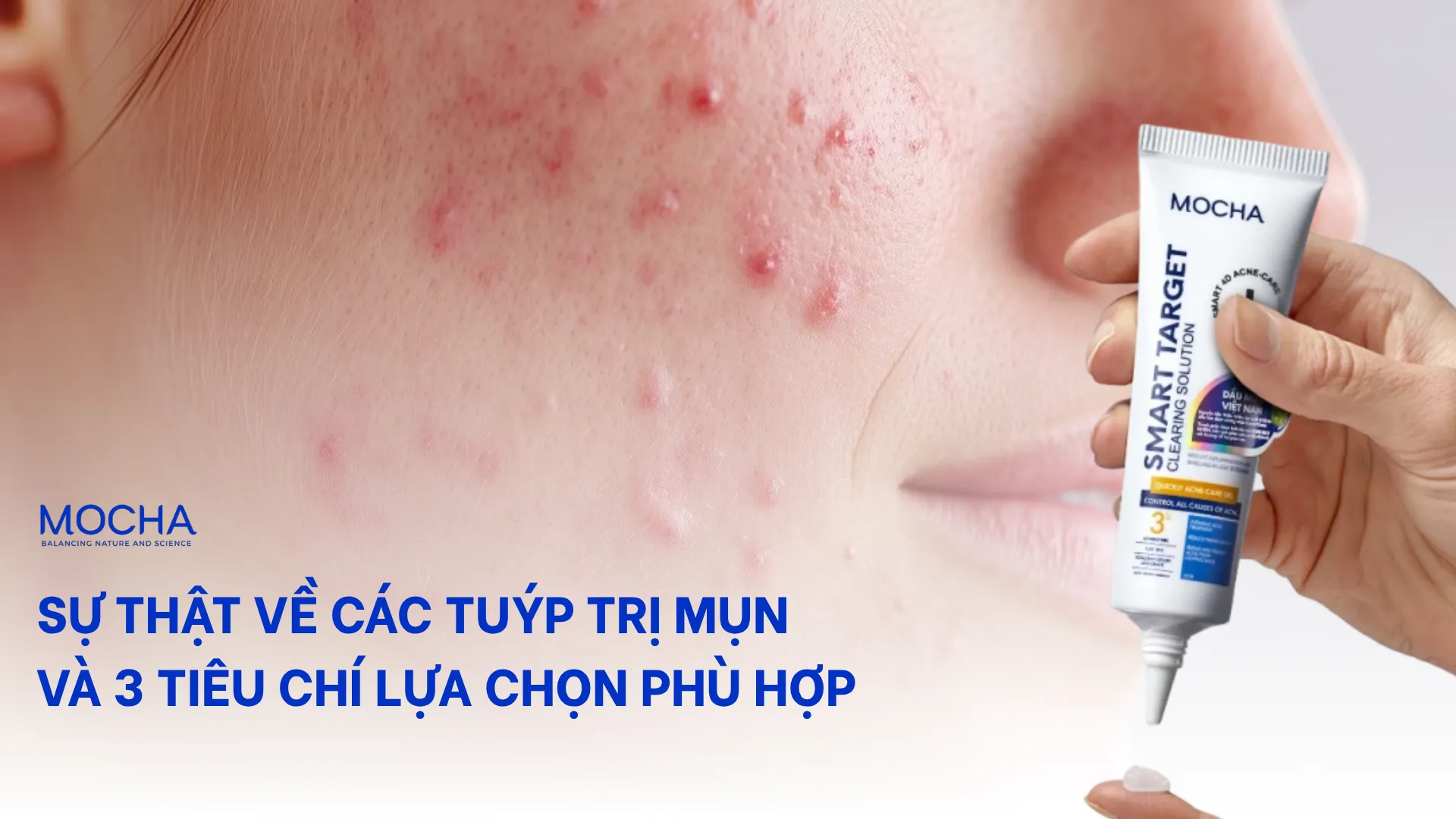 Sự thật về các tuýp trị mụn và 3 tiêu chí lựa chọn phù hợp