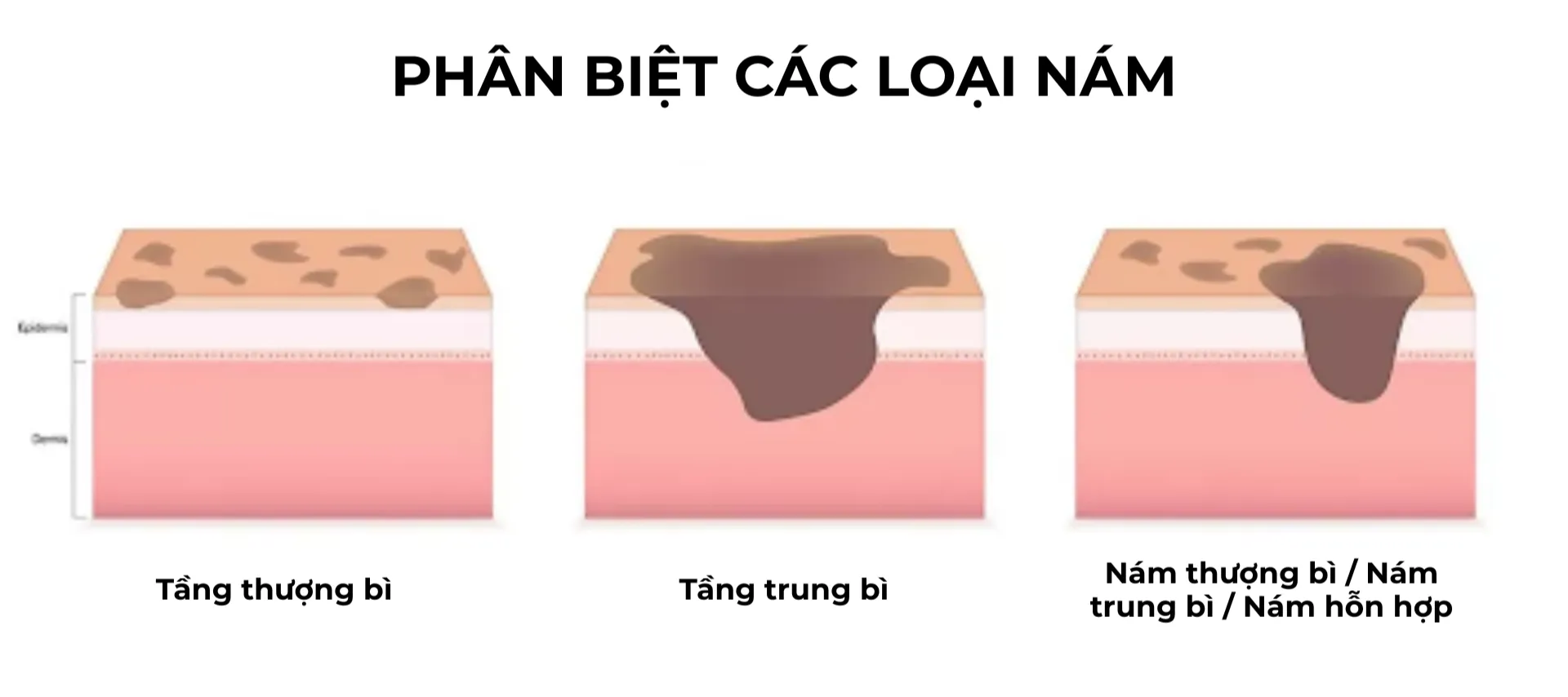 Xử lý tình trạng da sạm nám cho người trên 25 tuổi