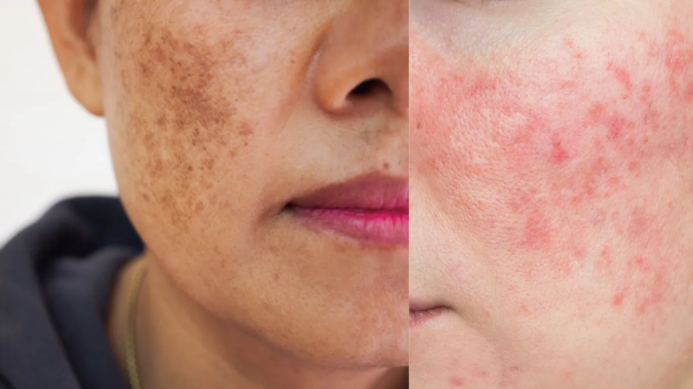 CÁCH KẾT HỢP SẢN PHẨM TRONG BỘ CHĂM SÓC DA SẠM NÁM