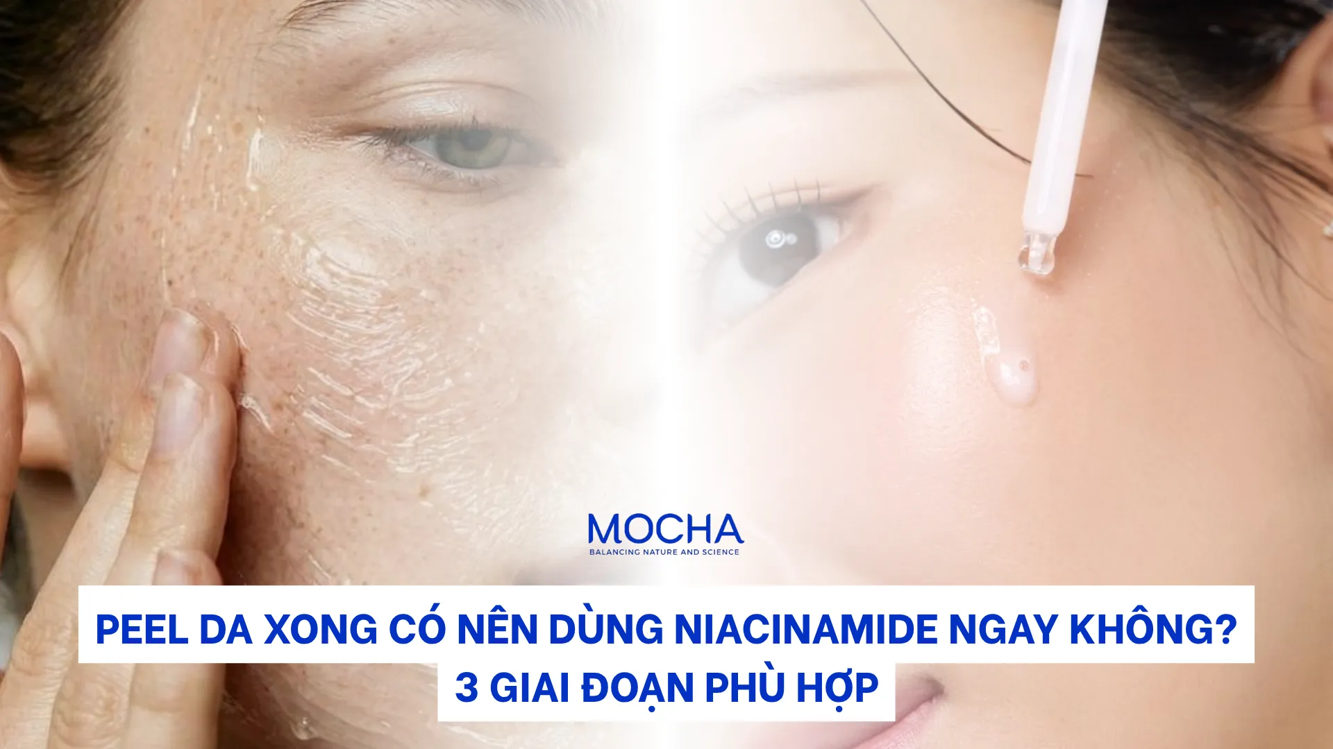 Peel da xong có nên dùng Niacinamide không? 3 giai đoạn phù hợp
