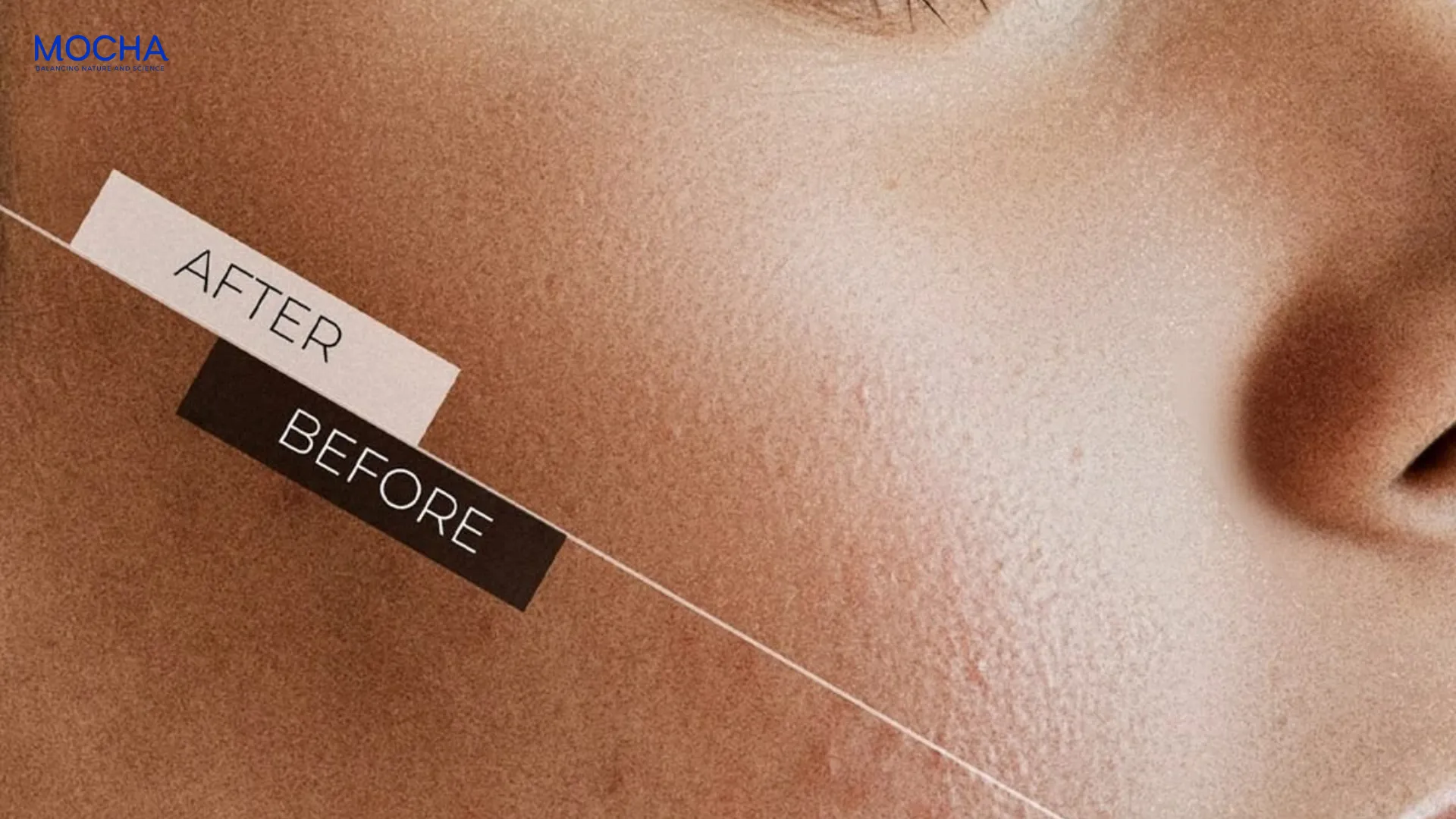 Tần suất peel da hợp lý là bao nhiêu? Lưu ý 3 cấp độ peel da