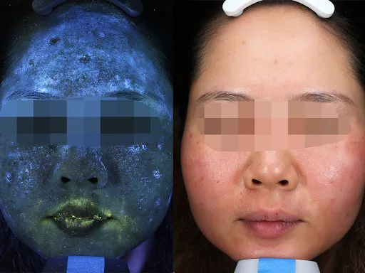 NHỔ TẬN GỐC CHÂN NÁM: SỰ THẬT PHÍA SAU QUẢNG CÁO