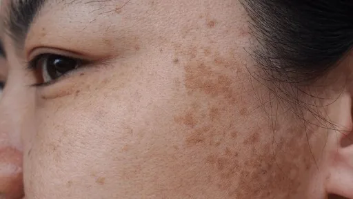 CHĂM SÓC DA NÁM NGÀY VÀ ĐÊM KHÁC NHAU THẾ NÀO?