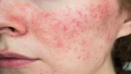 TOP NHỮNG LOẠI SERUM CẢI THIỆN THÂM SẠM NÁM HIỆU QUẢ
