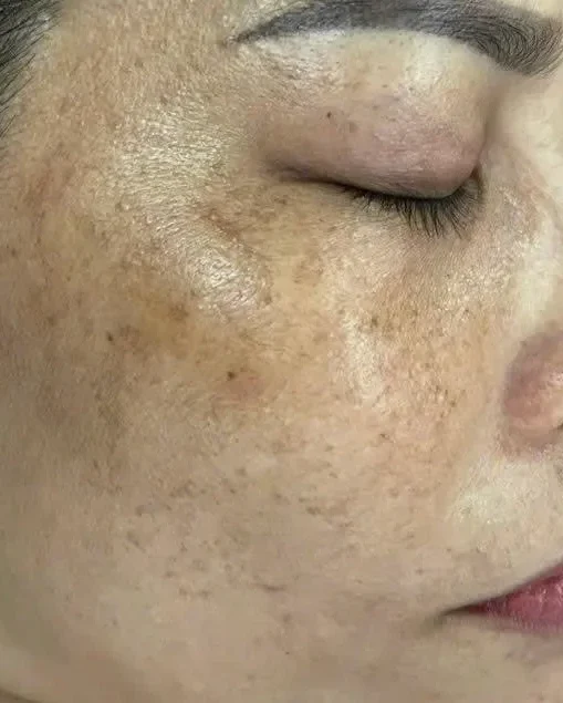 PHÂN BIỆT DA XỈN MÀU VÀ DA NÁM VÀ CÁCH CHĂM SÓC DA HIỆU QUẢ