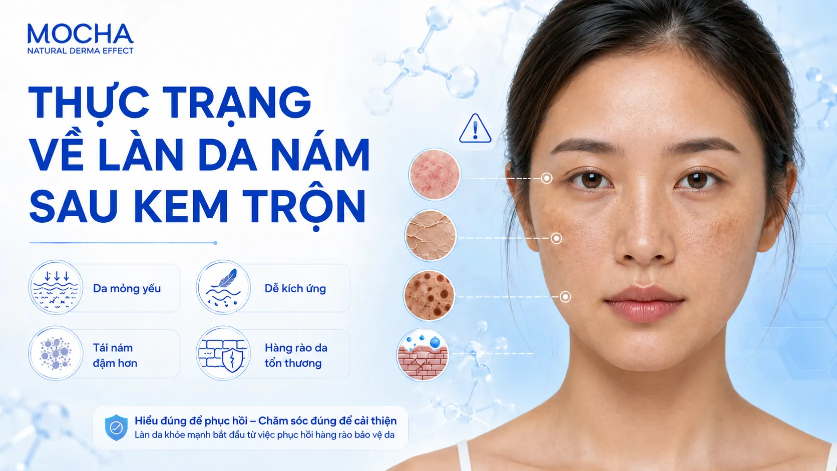 THỰC TRẠNG VỀ LÀN DA NÁM SAU KEM TRỘN