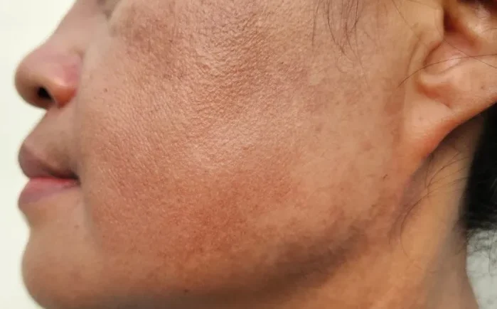 PHÂN BIỆT DA XỈN MÀU VÀ DA NÁM VÀ CÁCH CHĂM SÓC DA HIỆU QUẢ