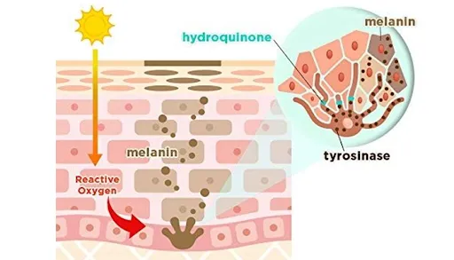 HẬU QUẢ VIỆC ĐIỀU TRỊ NÁM BẰNG HYDROQUINONE