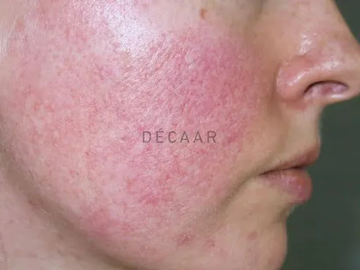 NHỮNG THÀNH PHẦN LÀM MỜ THÂM SẠM TỐT CHO DA NHẠY CẢM, DA SAU KEM TRỘN