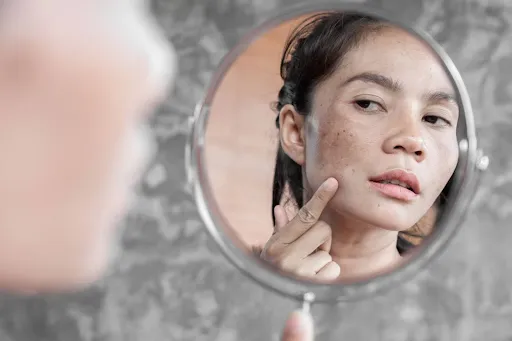 NHỮNG THÓI QUEN SINH HOẠT CÓ THỂ GÂY SẠM NÁM NẶNG HƠN