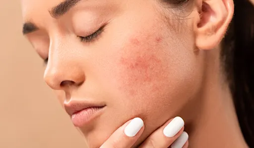 HẬU QUẢ VIỆC ĐIỀU TRỊ NÁM BẰNG HYDROQUINONE