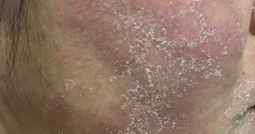 NHỮNG THÀNH PHẦN LÀM MỜ THÂM SẠM TỐT CHO DA NHẠY CẢM, DA SAU KEM TRỘN