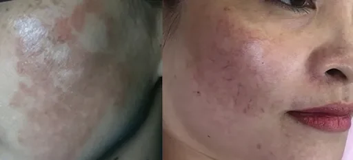 THỰC TRẠNG VỀ LÀN DA NÁM SAU KEM TRỘN
