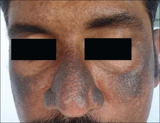 HẬU QUẢ VIỆC ĐIỀU TRỊ NÁM BẰNG HYDROQUINONE