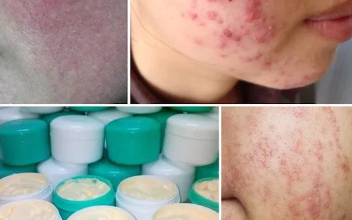 NHỮNG THÓI QUEN SINH HOẠT CÓ THỂ GÂY SẠM NÁM NẶNG HƠN